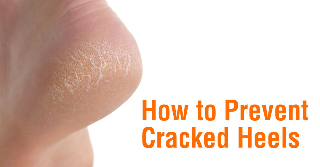 How to Prevent Cracked Heels