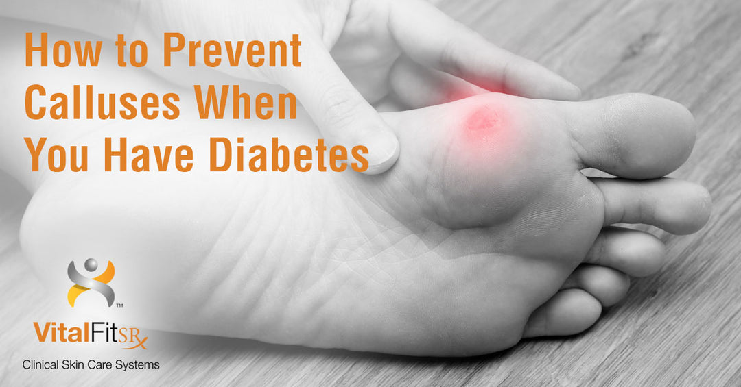 How to Prevent Calluses When You Have Diabetes
