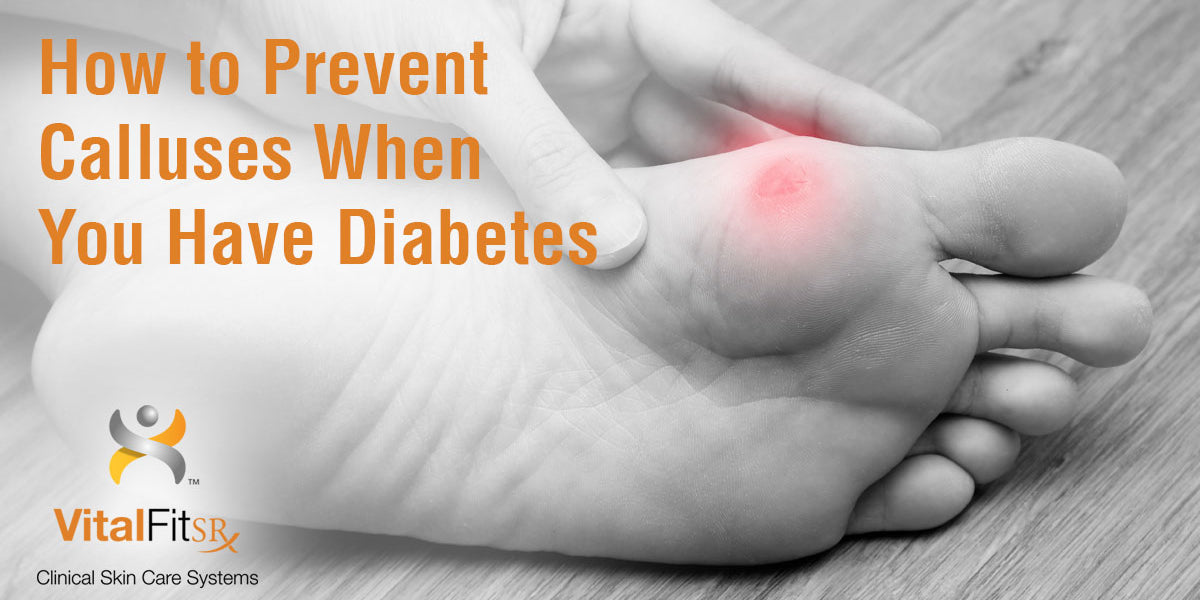 How to Prevent Calluses When You Have Diabetes – VitalFitSR